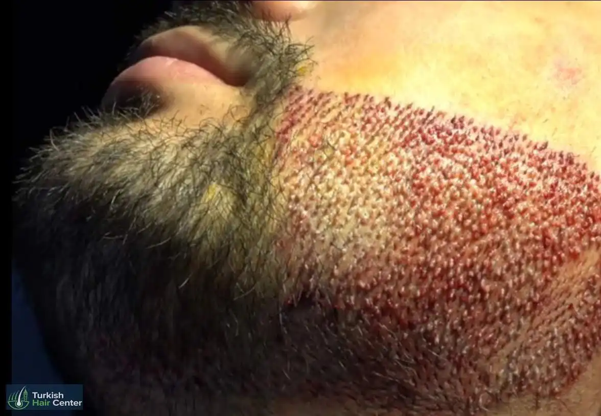 Beard Transplant Guide: Everything You Need to Know