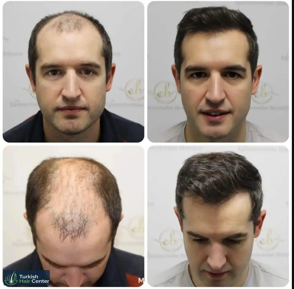 Hair Transplant Before and After: What to Realistically Expect